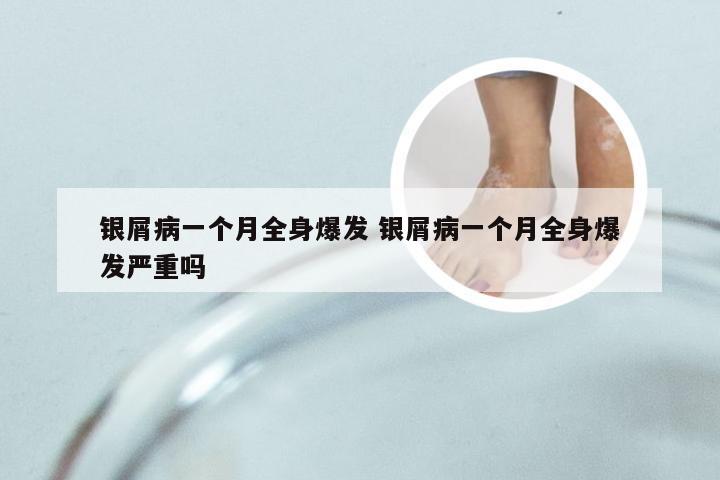 银屑病一个月全身爆发 银屑病一个月全身爆发严重吗