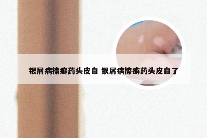 银屑病擦癣药头皮白 银屑病擦癣药头皮白了