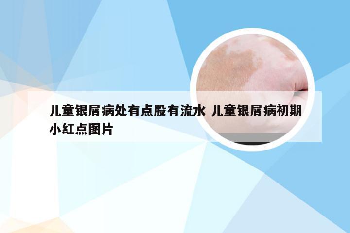 儿童银屑病处有点股有流水 儿童银屑病初期小红点图片