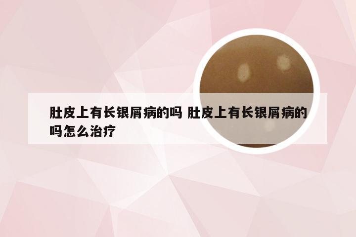 肚皮上有长银屑病的吗 肚皮上有长银屑病的吗怎么治疗