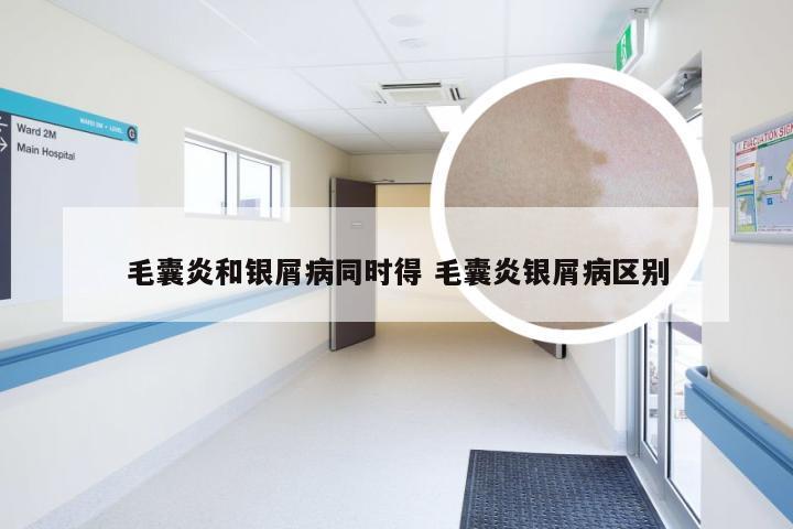 毛囊炎和银屑病同时得 毛囊炎银屑病区别