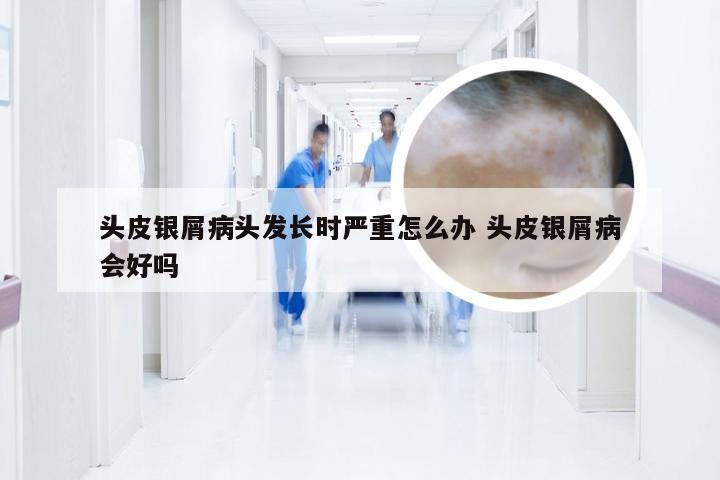 头皮银屑病头发长时严重怎么办 头皮银屑病会好吗