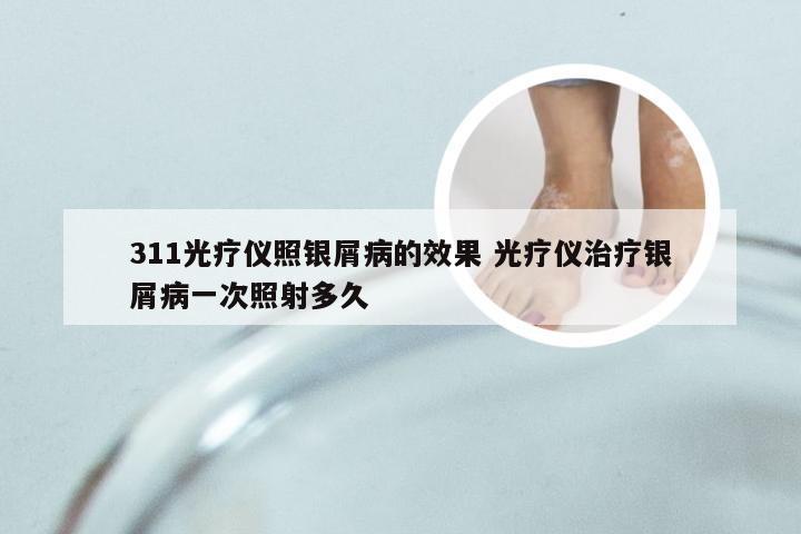 311光疗仪照银屑病的效果 光疗仪治疗银屑病一次照射多久