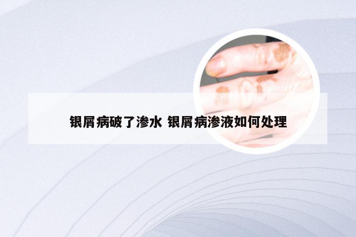 银屑病破了渗水 银屑病渗液如何处理