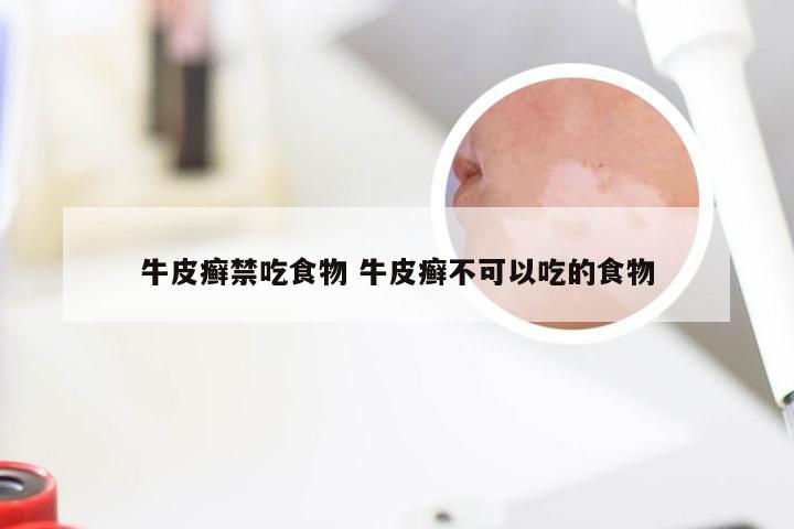 牛皮癣禁吃食物 牛皮癣不可以吃的食物