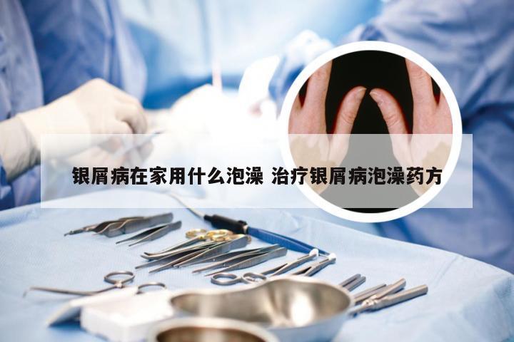 银屑病在家用什么泡澡 治疗银屑病泡澡药方