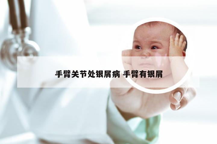 手臂关节处银屑病 手臂有银屑