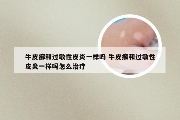 牛皮癣和过敏性皮炎一样吗 牛皮癣和过敏性皮炎一样吗怎么治疗