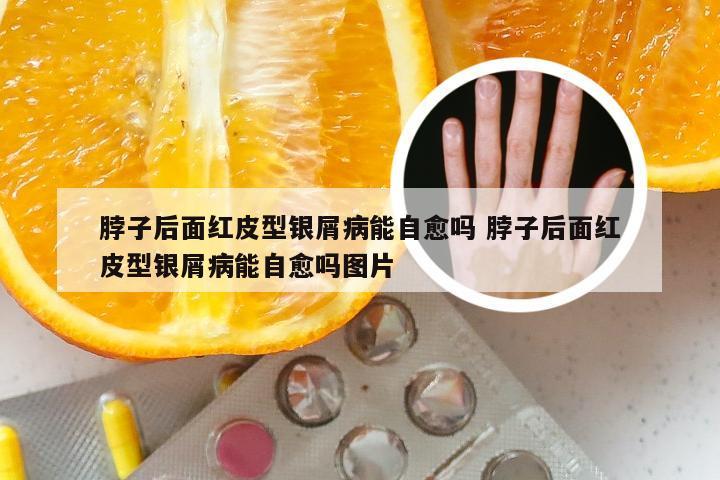 脖子后面红皮型银屑病能自愈吗 脖子后面红皮型银屑病能自愈吗图片