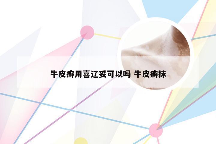 牛皮癣用喜辽妥可以吗 牛皮癣抹