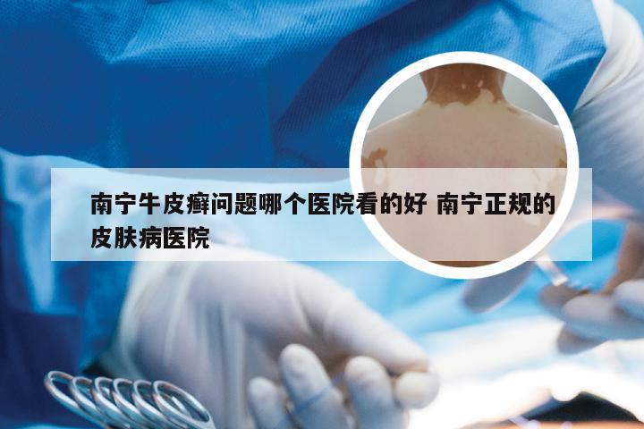 南宁牛皮癣问题哪个医院看的好 南宁正规的皮肤病医院