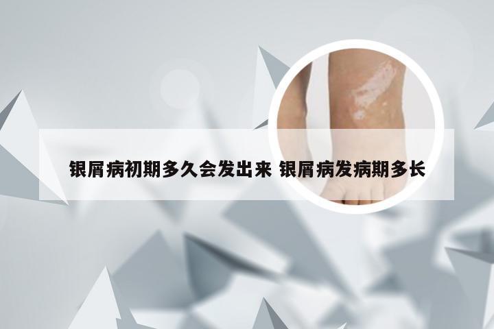 银屑病初期多久会发出来 银屑病发病期多长