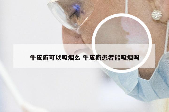 牛皮癣可以吸烟么 牛皮癣患者能吸烟吗