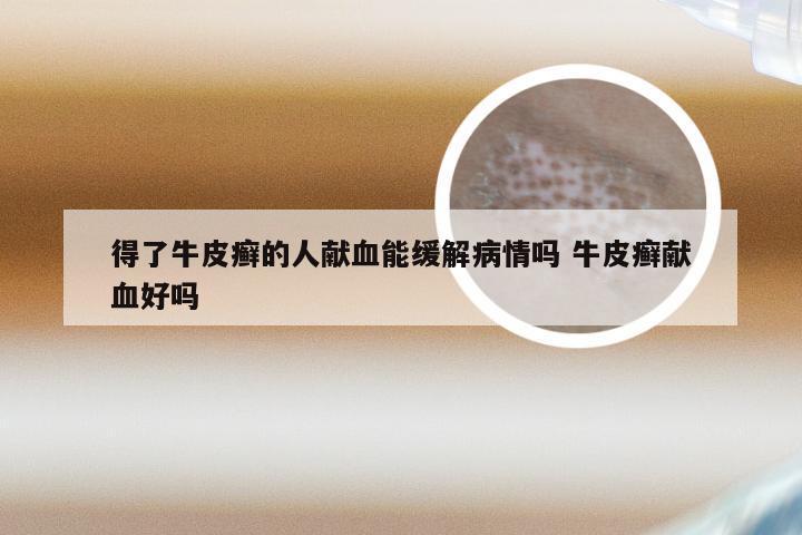得了牛皮癣的人献血能缓解病情吗 牛皮癣献血好吗