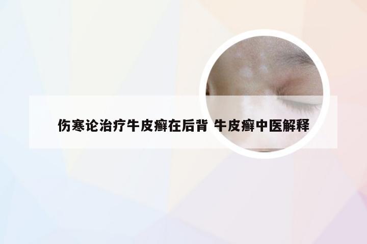 伤寒论治疗牛皮癣在后背 牛皮癣中医解释