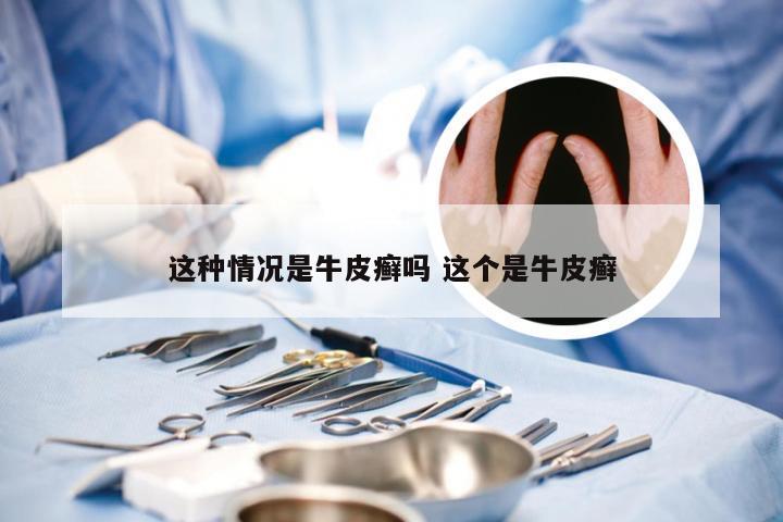 这种情况是牛皮癣吗 这个是牛皮癣