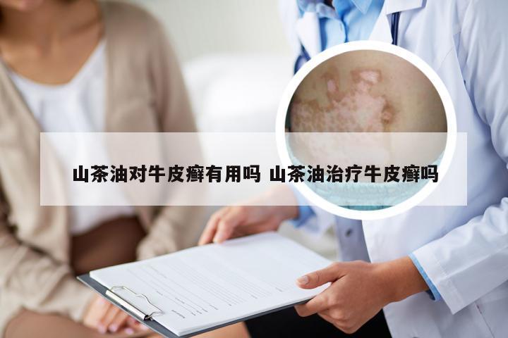 山茶油对牛皮癣有用吗 山茶油治疗牛皮癣吗