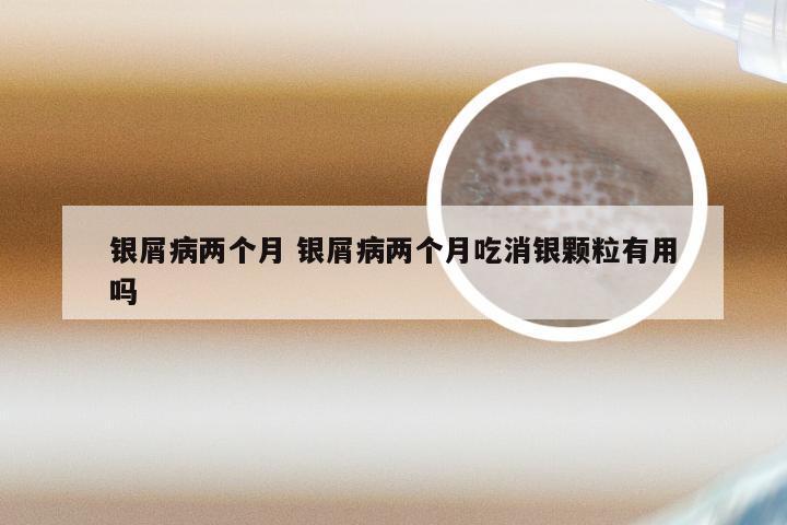 银屑病两个月 银屑病两个月吃消银颗粒有用吗