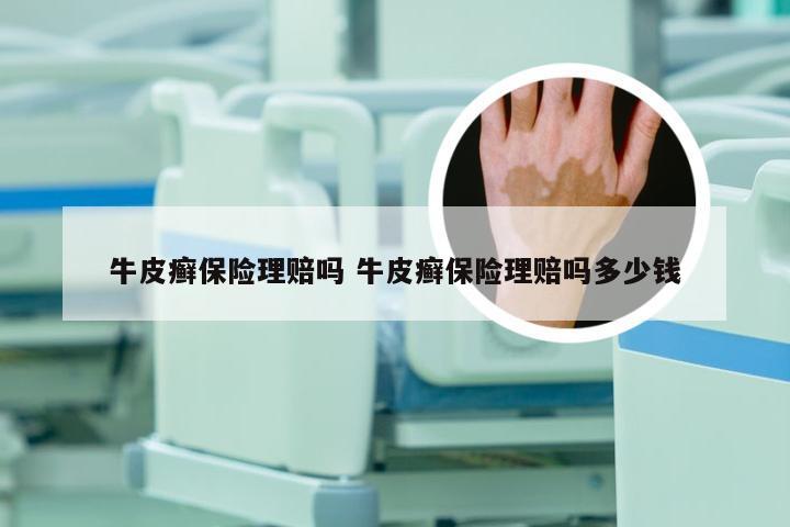 牛皮癣保险理赔吗 牛皮癣保险理赔吗多少钱