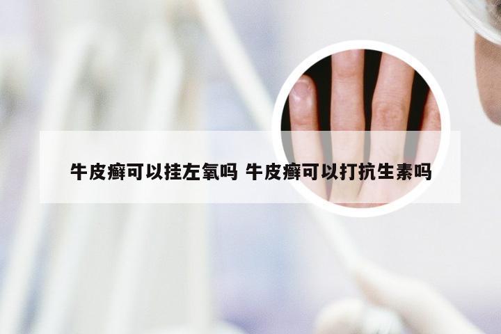 牛皮癣可以挂左氧吗 牛皮癣可以打抗生素吗