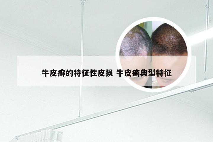 牛皮癣的特征性皮损 牛皮癣典型特征
