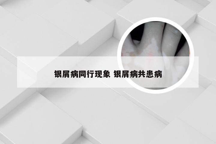 银屑病同行现象 银屑病共患病