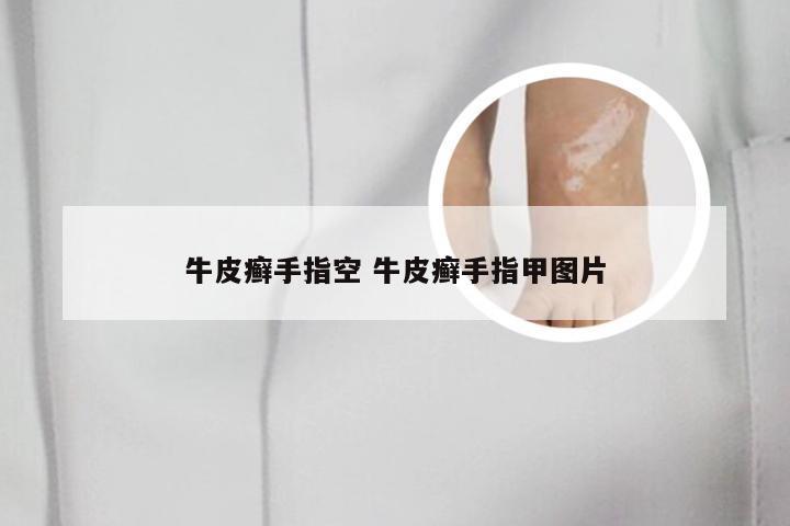 牛皮癣手指空 牛皮癣手指甲图片