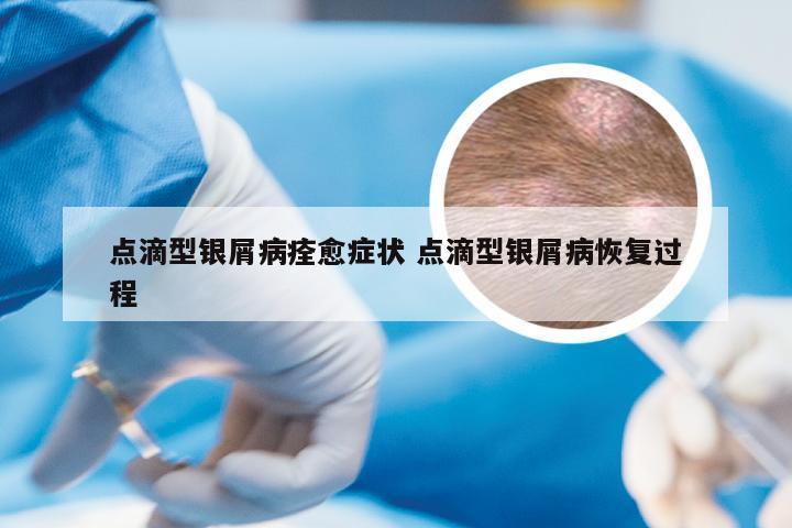 点滴型银屑病痊愈症状 点滴型银屑病恢复过程