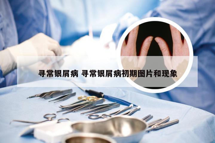 寻常银屑病 寻常银屑病初期图片和现象