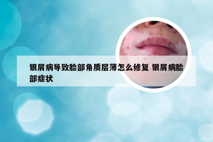 银屑病导致脸部角质层薄怎么修复 银屑病脸部症状