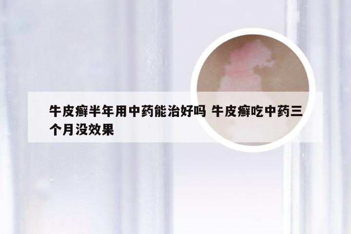 牛皮癣半年用中药能治好吗 牛皮癣吃中药三个月没效果