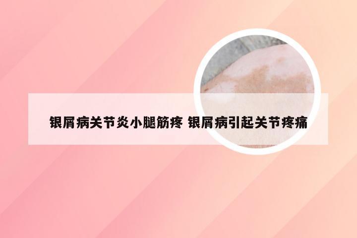 银屑病关节炎小腿筋疼 银屑病引起关节疼痛