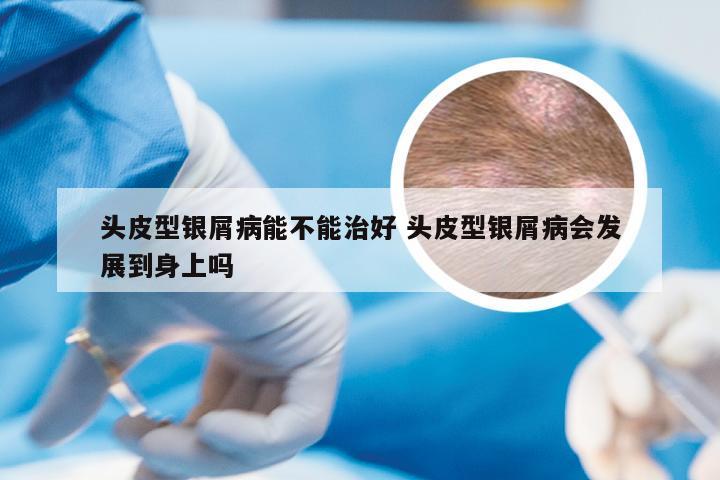 头皮型银屑病能不能治好 头皮型银屑病会发展到身上吗