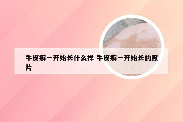 牛皮癣一开始长什么样 牛皮癣一开始长的照片