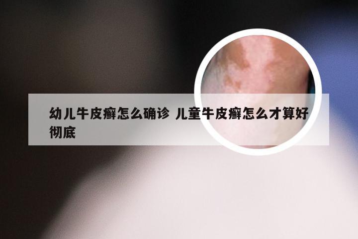 幼儿牛皮癣怎么确诊 儿童牛皮癣怎么才算好彻底