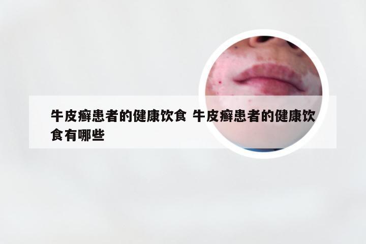 牛皮癣患者的健康饮食 牛皮癣患者的健康饮食有哪些