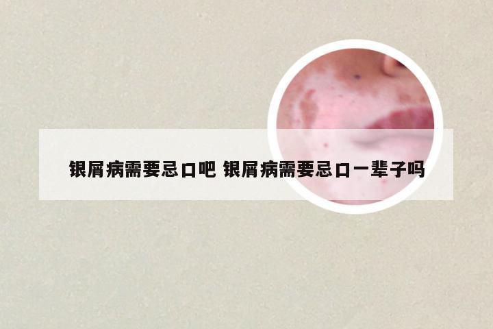 银屑病需要忌口吧 银屑病需要忌口一辈子吗