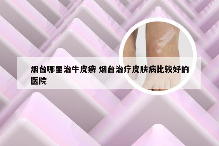 烟台哪里治牛皮癣 烟台治疗皮肤病比较好的医院