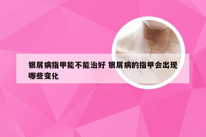 银屑病指甲能不能治好 银屑病的指甲会出现哪些变化