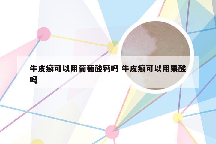 牛皮癣可以用葡萄酸钙吗 牛皮癣可以用果酸吗