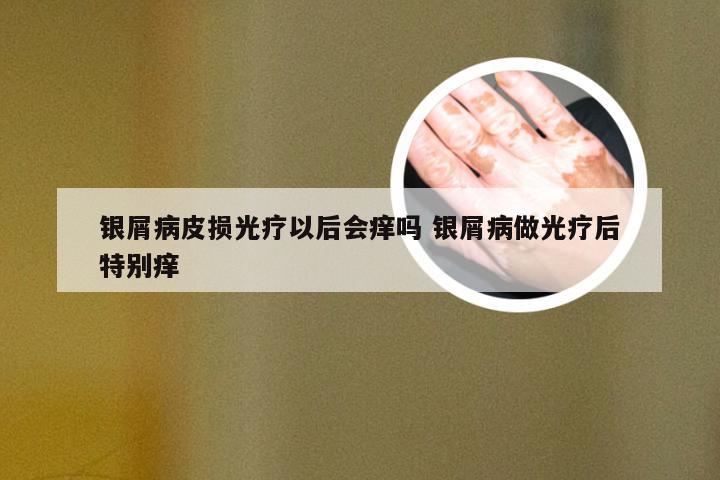 银屑病皮损光疗以后会痒吗 银屑病做光疗后特别痒