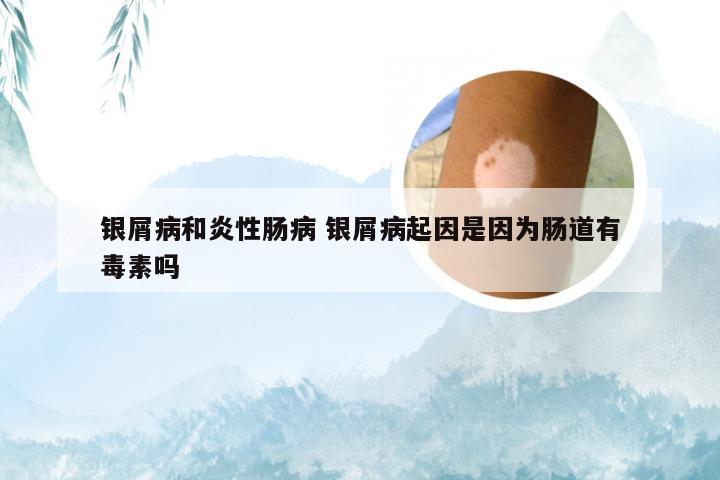 银屑病和炎性肠病 银屑病起因是因为肠道有毒素吗