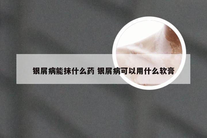银屑病能抹什么药 银屑病可以用什么软膏