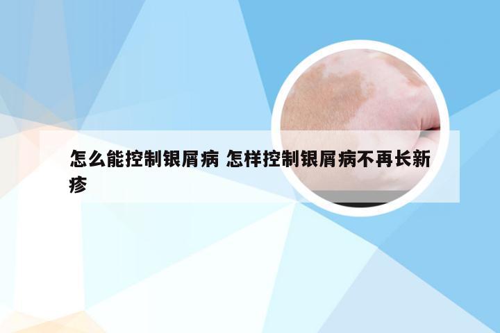 怎么能控制银屑病 怎样控制银屑病不再长新疹