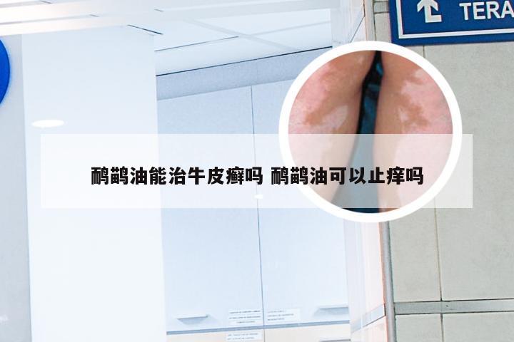 鸸鹋油能治牛皮癣吗 鸸鹋油可以止痒吗