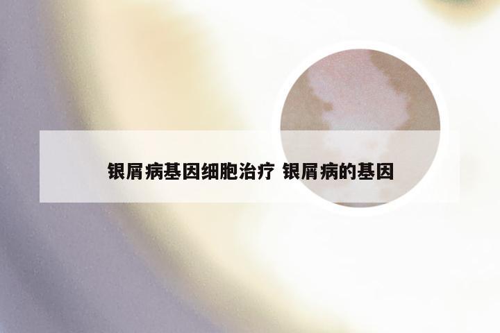 银屑病基因细胞治疗 银屑病的基因