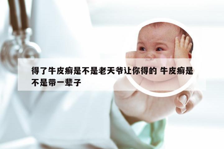 得了牛皮癣是不是老天爷让你得的 牛皮癣是不是带一辈子