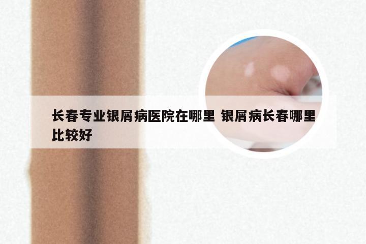 长春专业银屑病医院在哪里 银屑病长春哪里比较好