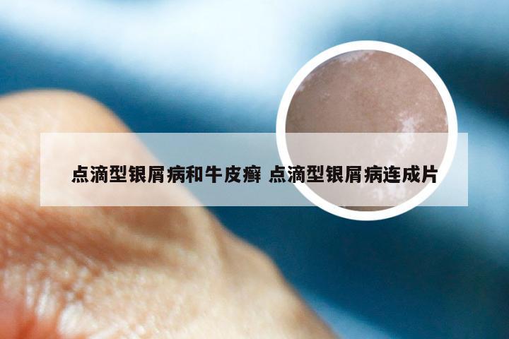点滴型银屑病和牛皮癣 点滴型银屑病连成片
