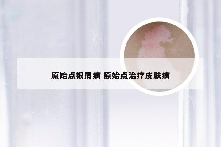 原始点银屑病 原始点治疗皮肤病